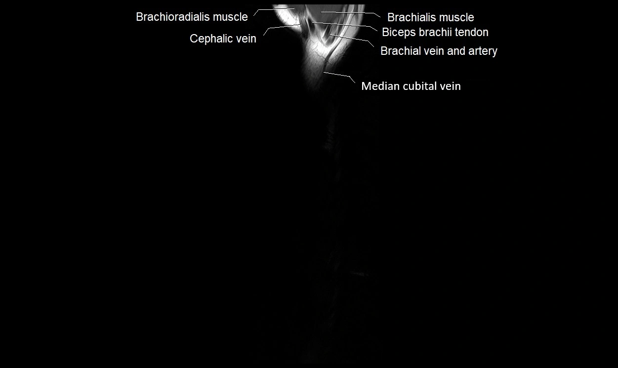 MRI 3T forearm coronal cross sectional anatomy image 1.webp
